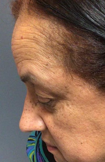 Moles, Warts, Skin Tags Before & After Gallery - Patient 373735 - Image 2