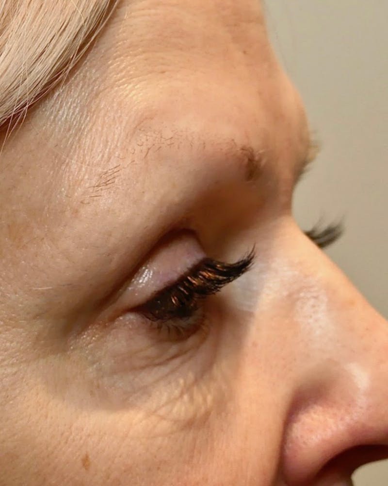 Morpheus8 Skin Tightening Before & After Gallery - Patient 378260 - Image 1