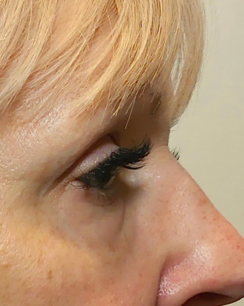 Morpheus8 Skin Tightening Before & After Gallery - Patient 378260 - Image 2