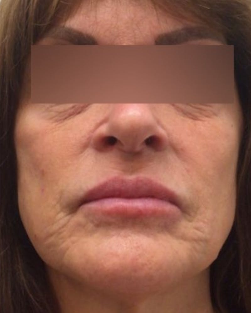 Morpheus8 Skin Tightening Before & After Gallery - Patient 339476 - Image 1