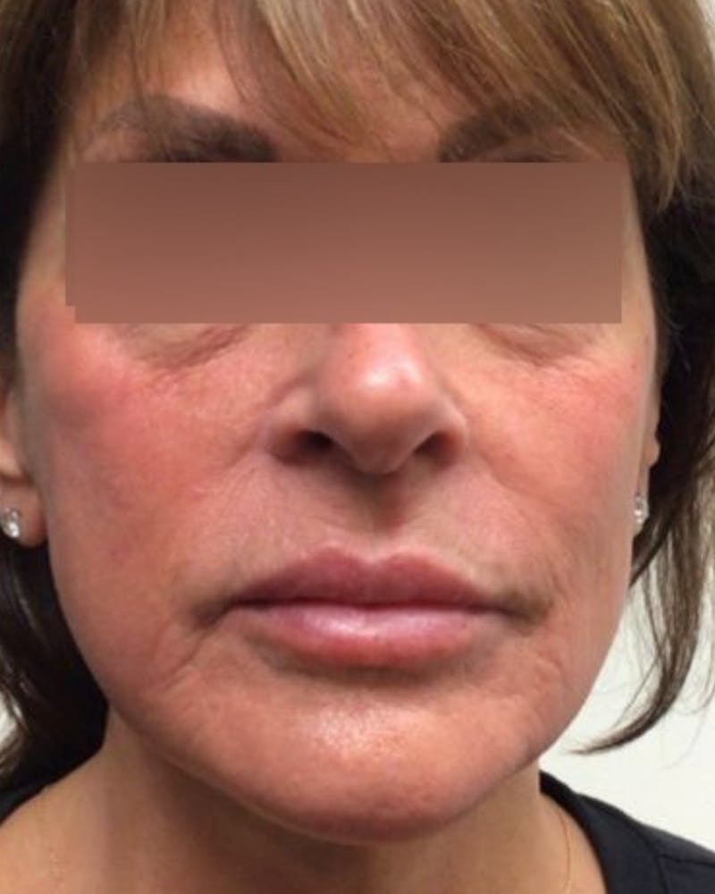 Morpheus8 Skin Tightening Before & After Gallery - Patient 339476 - Image 2