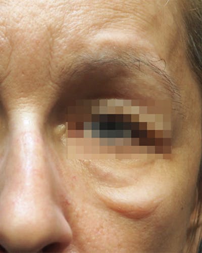 Morpheus8 Skin Tightening Before & After Gallery - Patient 336978 - Image 1
