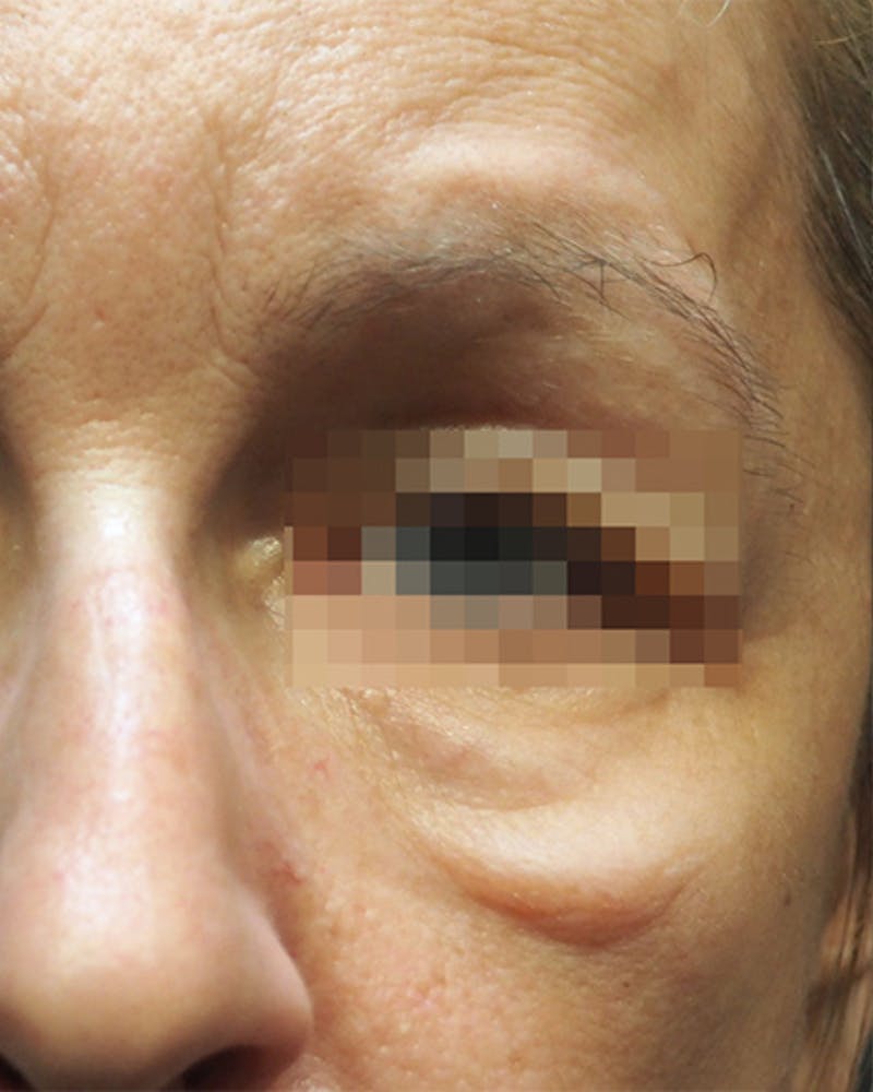 Morpheus8 Skin Tightening Before & After Gallery - Patient 336978 - Image 1