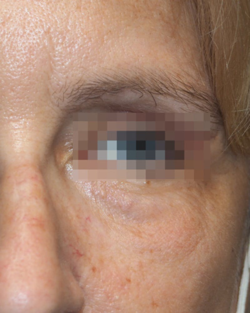 Morpheus8 Skin Tightening Before & After Gallery - Patient 336978 - Image 2