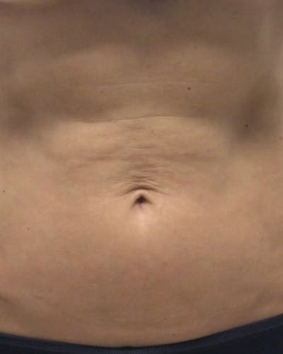 Morpheus8 Skin Tightening Before & After Gallery - Patient 137954 - Image 1