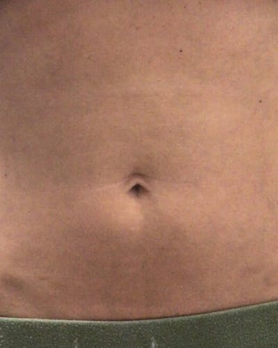 Morpheus8 Skin Tightening Before & After Gallery - Patient 137954 - Image 2