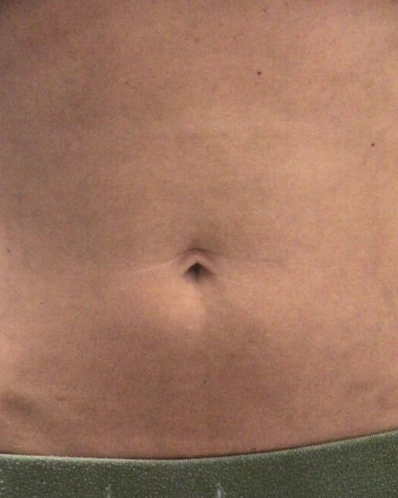 Morpheus8 Skin Tightening Before & After Gallery - Patient 137954 - Image 2
