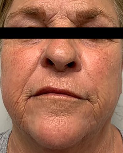Morpheus8 Skin Tightening Before & After Gallery - Patient 232261 - Image 1