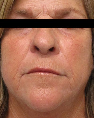 Morpheus8 Skin Tightening Before & After Gallery - Patient 232261 - Image 2