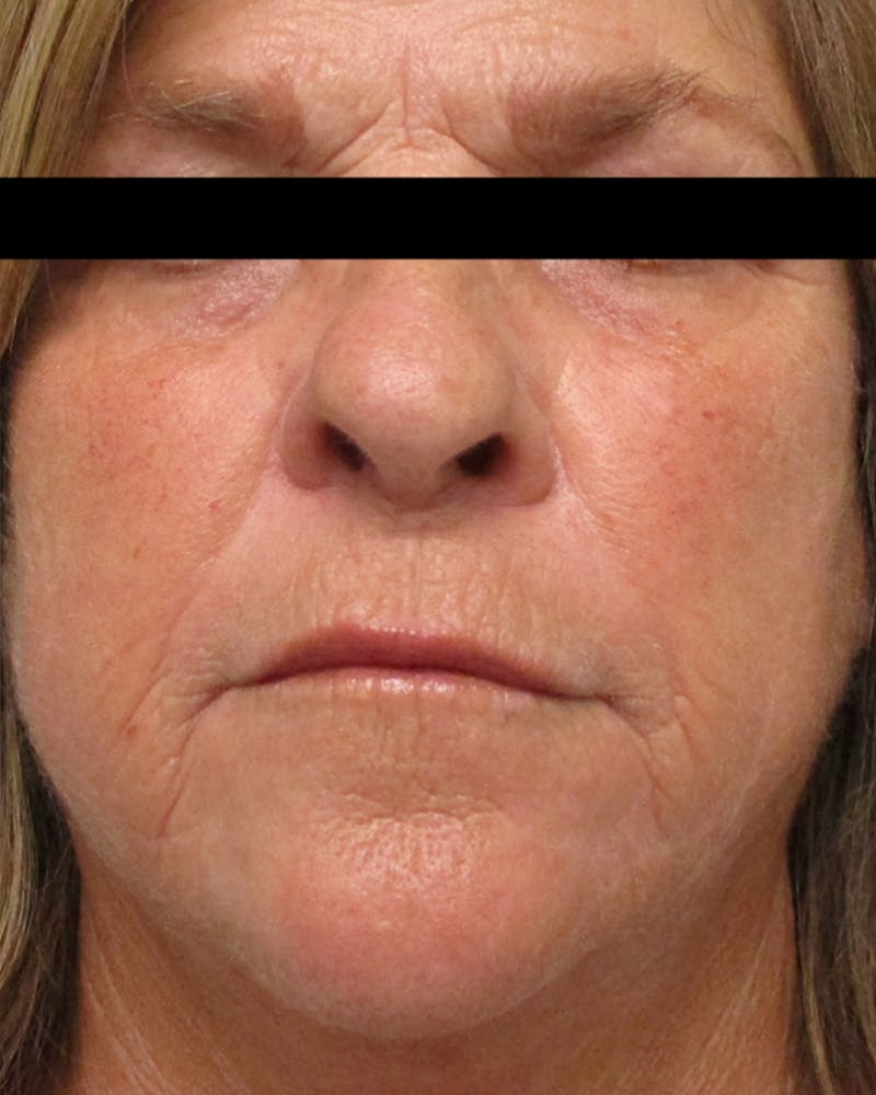 Morpheus8 Skin Tightening Before & After Gallery - Patient 232261 - Image 2