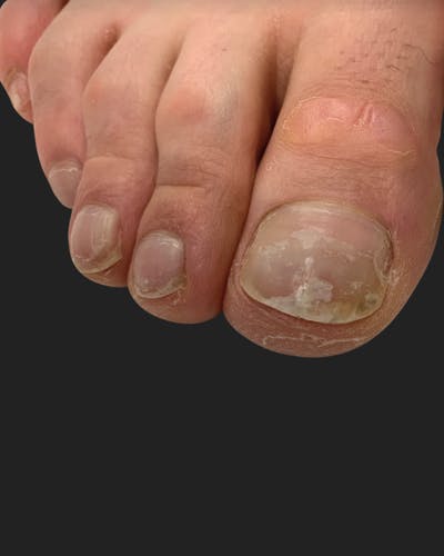 Nail Rejuvenation Before & After Gallery - Patient 162031 - Image 1