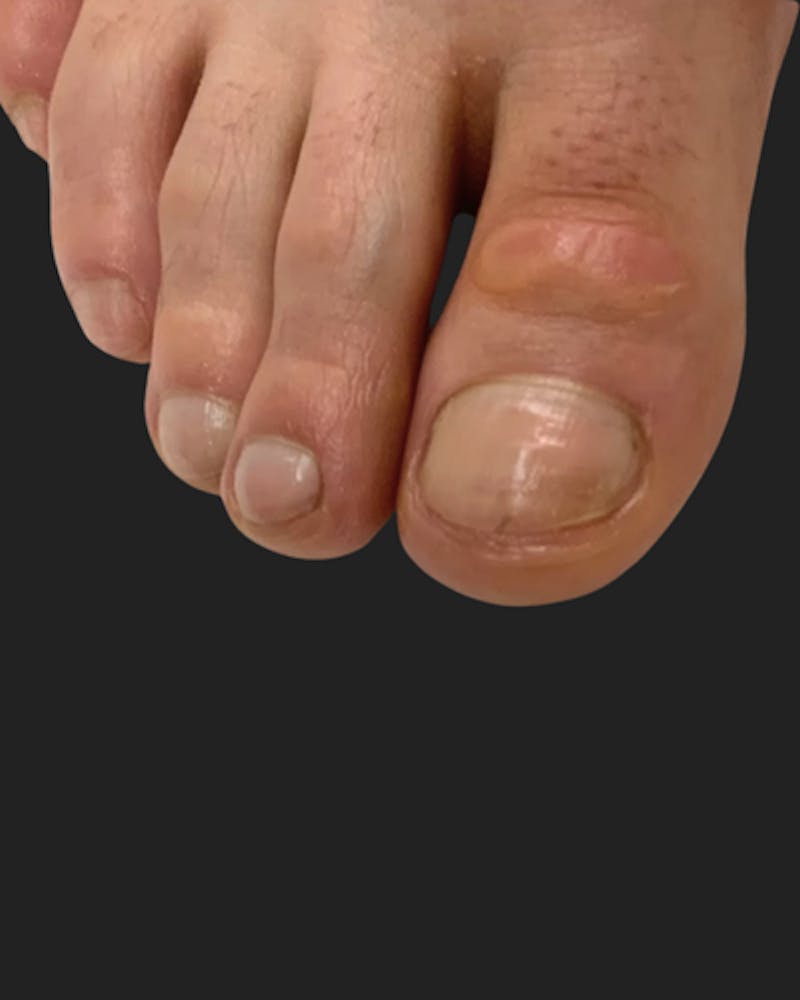 Nail Rejuvenation Before & After Gallery - Patient 162031 - Image 2
