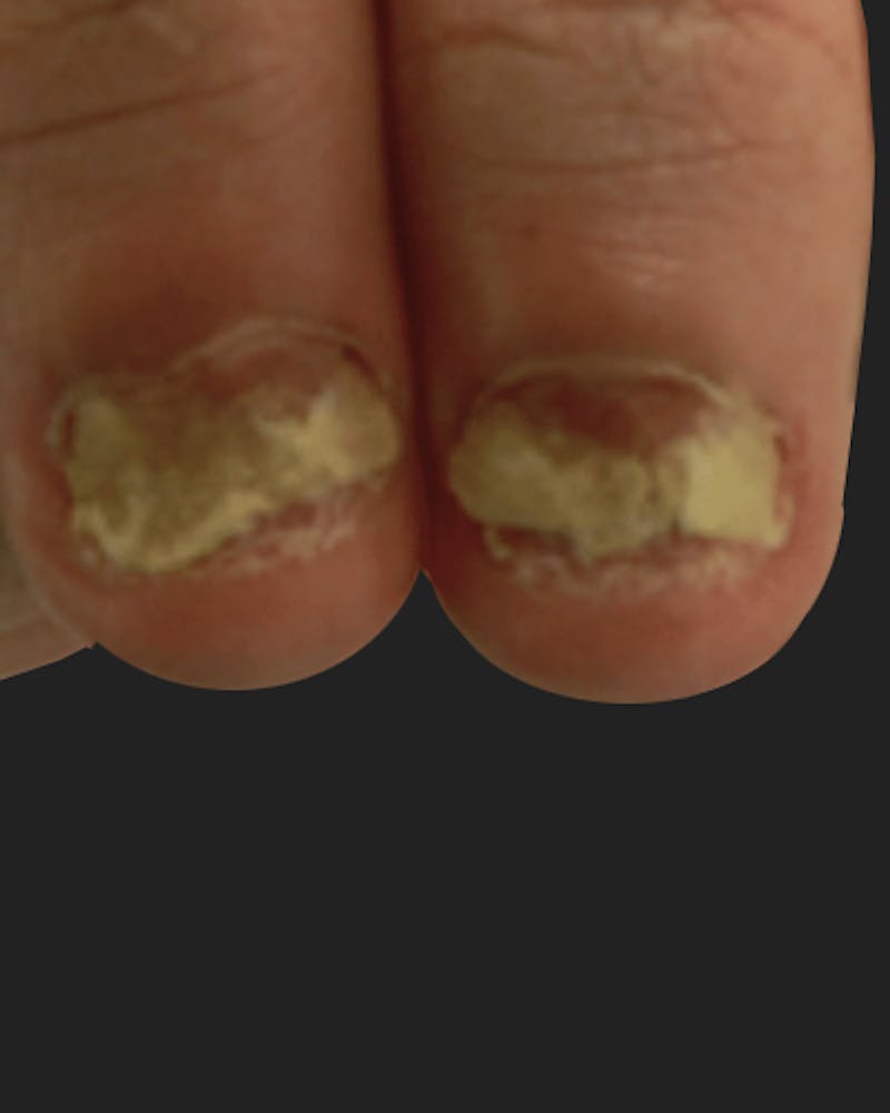 Nail Rejuvenation Before & After Gallery - Patient 492104 - Image 1