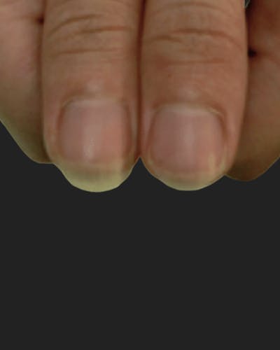 Nail Rejuvenation Before & After Gallery - Patient 492104 - Image 2