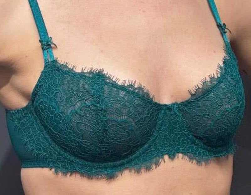 Non Surgical Breast Lift Before & After Gallery - Patient 397306 - Image 1