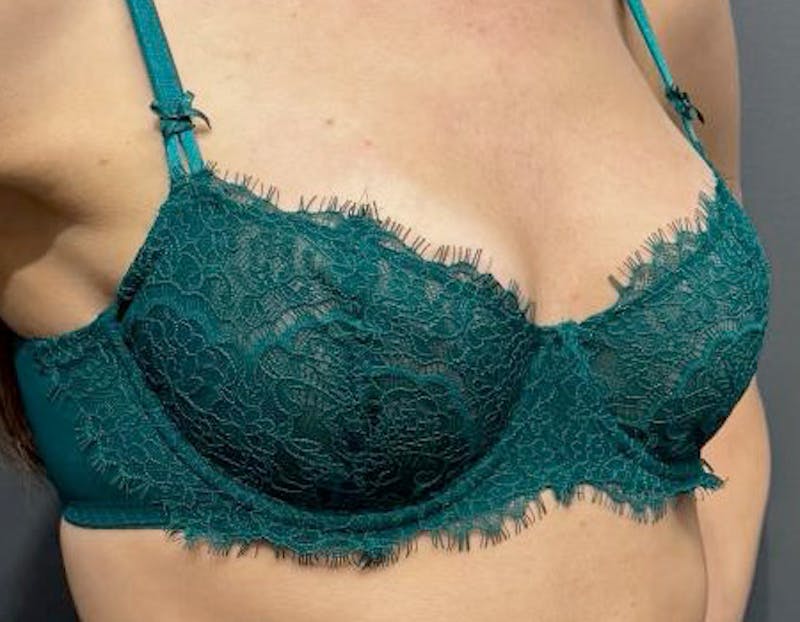 Non Surgical Breast Lift Before & After Gallery - Patient 397306 - Image 2