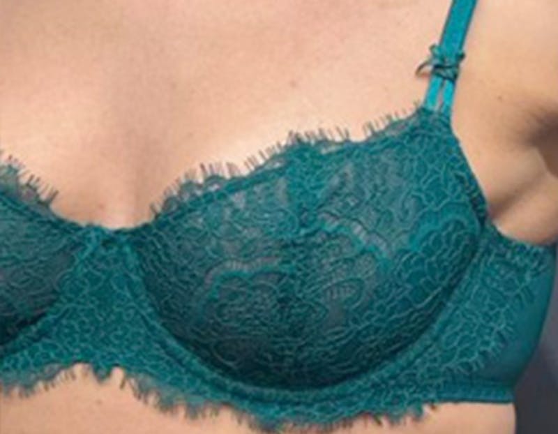 Non Surgical Breast Lift Before & After Gallery - Patient 183297 - Image 1