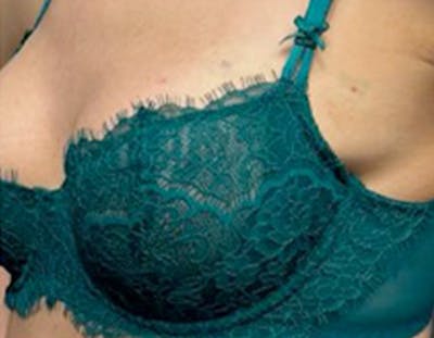 Non Surgical Breast Lift Before & After Gallery - Patient 183297 - Image 2