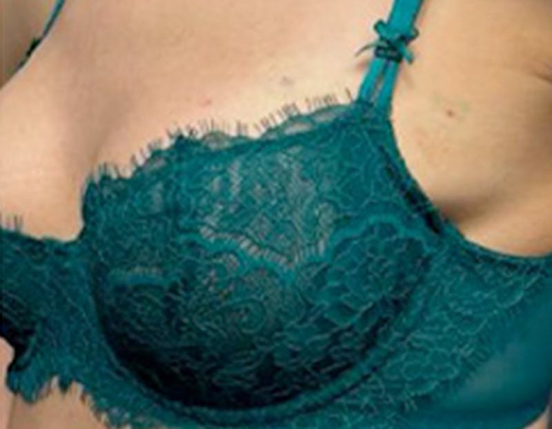 Non Surgical Breast Lift Before & After Gallery - Patient 183297 - Image 2