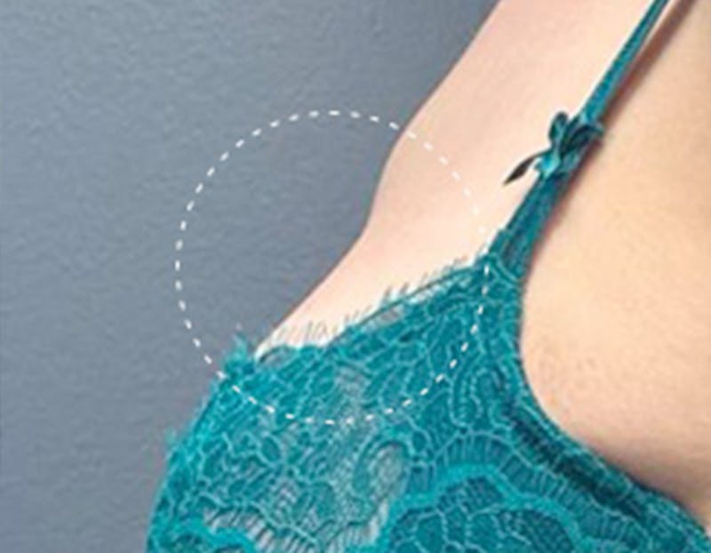 Non Surgical Breast Lift Before & After Gallery - Patient 137404 - Image 1