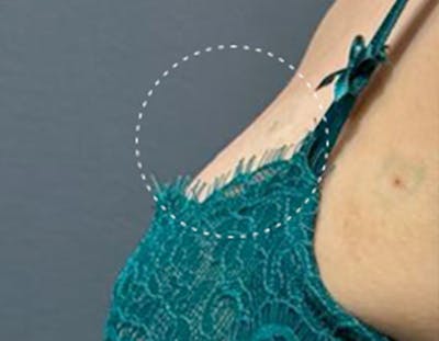 Non Surgical Breast Lift Before & After Gallery - Patient 137404 - Image 2