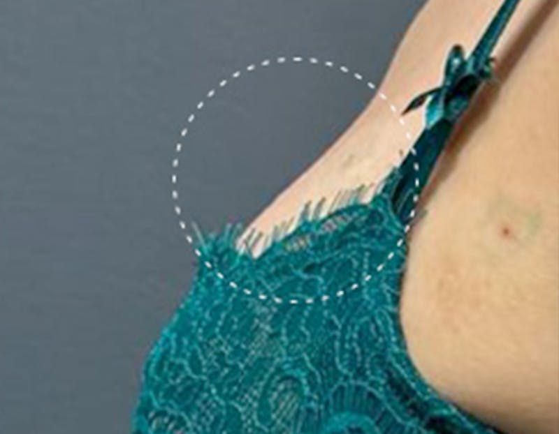 Non Surgical Breast Lift Before & After Gallery - Patient 137404 - Image 2