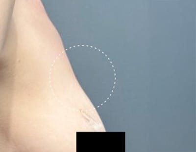 Non Surgical Breast Lift Before & After Gallery - Patient 170437 - Image 1