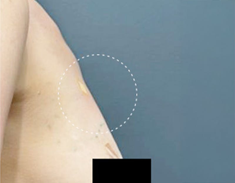 Non Surgical Breast Lift Before & After Gallery - Patient 170437 - Image 2