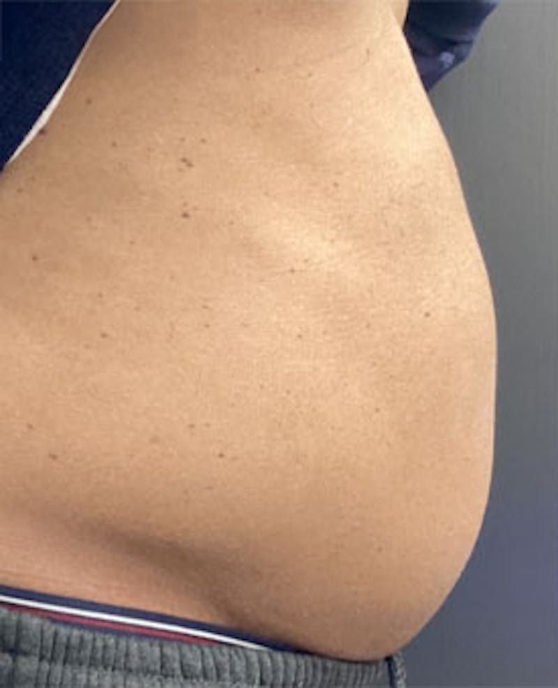 PCDC Lipodissolve Before & After Gallery - Patient 161925 - Image 1