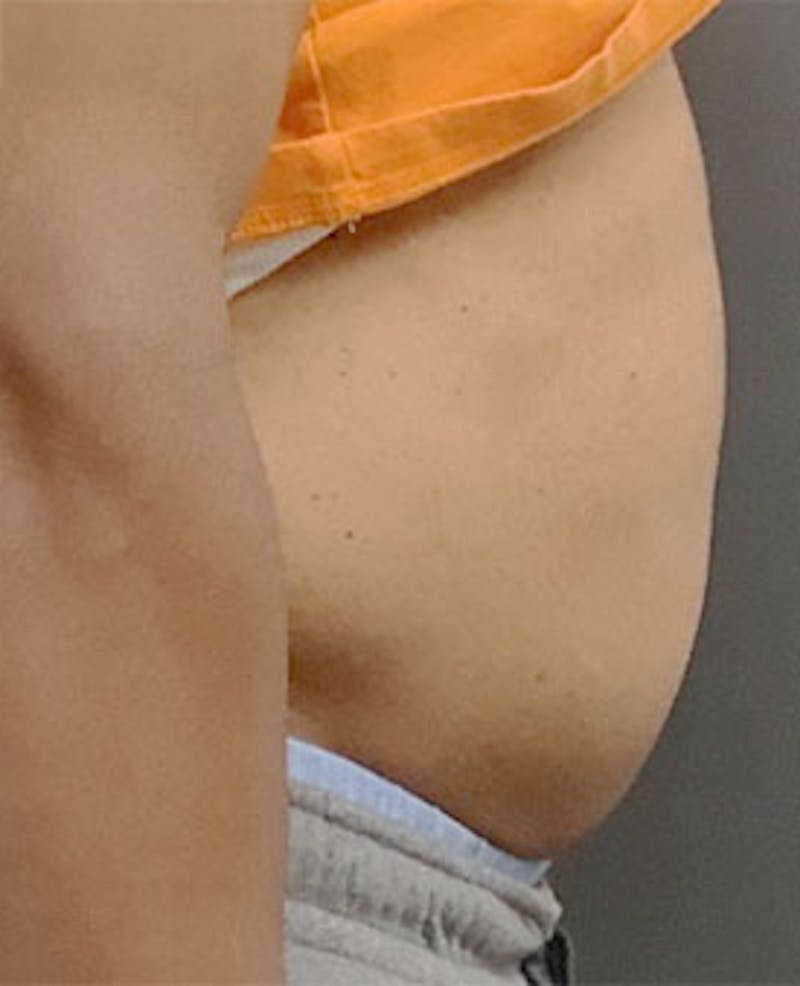PCDC Lipodissolve Before & After Gallery - Patient 161925 - Image 2