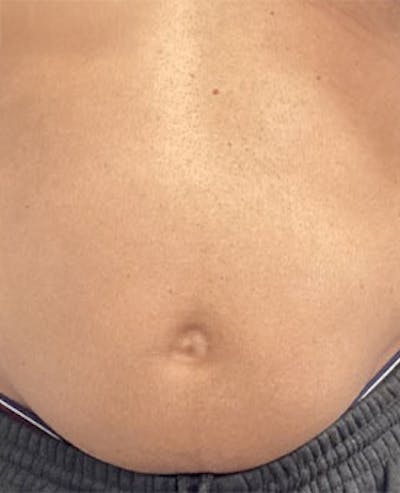 PCDC Lipodissolve Before & After Gallery - Patient 319168 - Image 1