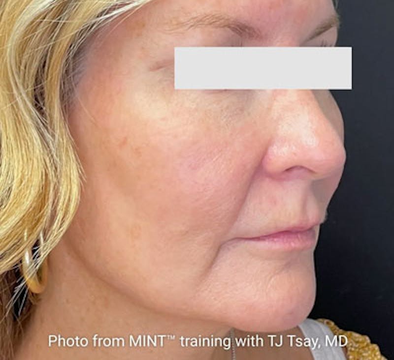PDO Thread Lift Before & After Gallery - Patient 369866 - Image 1