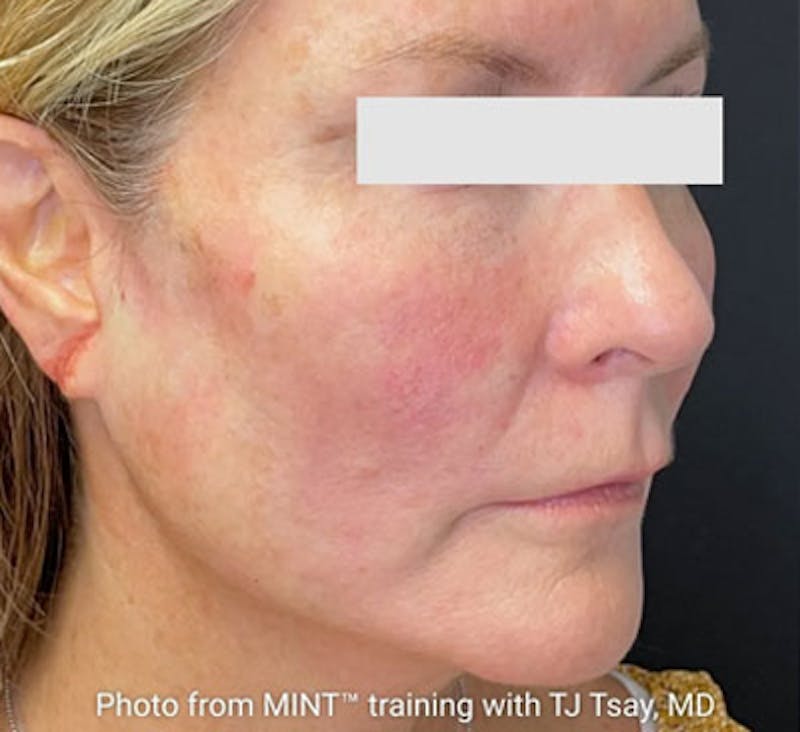 PDO Thread Lift Before & After Gallery - Patient 369866 - Image 2
