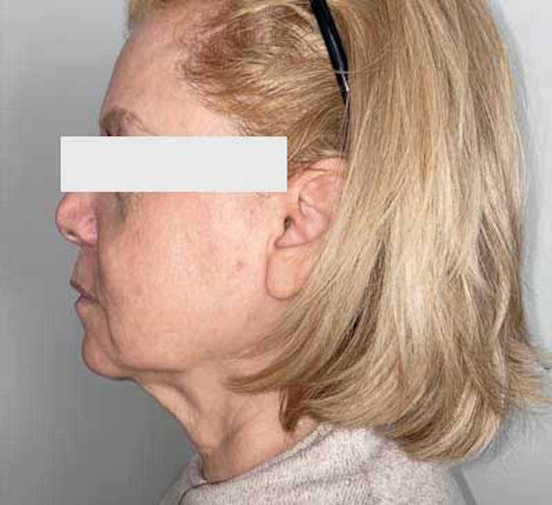 PDO Thread Lift Before & After Gallery - Patient 108331 - Image 1