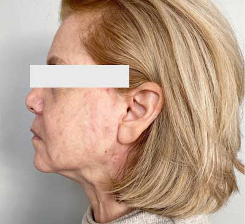 PDO Thread Lift Before & After Gallery - Patient 108331 - Image 2