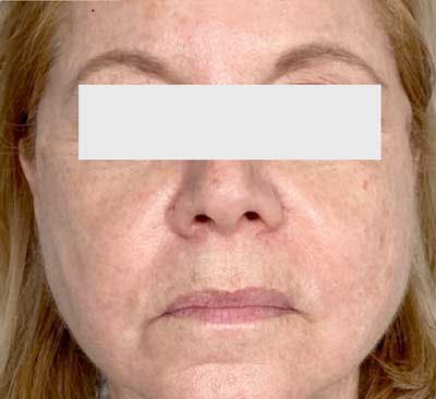 PDO Thread Lift Before & After Gallery - Patient 201312 - Image 1