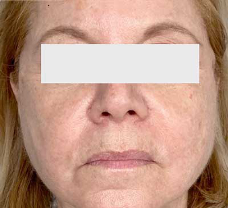 PDO Thread Lift Before & After Gallery - Patient 201312 - Image 1