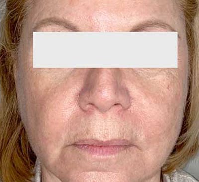 PDO Thread Lift Before & After Gallery - Patient 201312 - Image 2