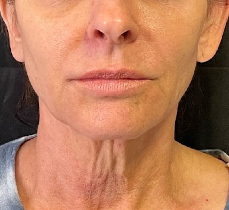PDO Thread Lift Before & After Gallery - Patient 263840 - Image 1