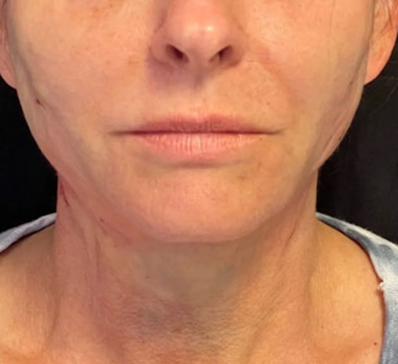 PDO Thread Lift Before & After Gallery - Patient 263840 - Image 2
