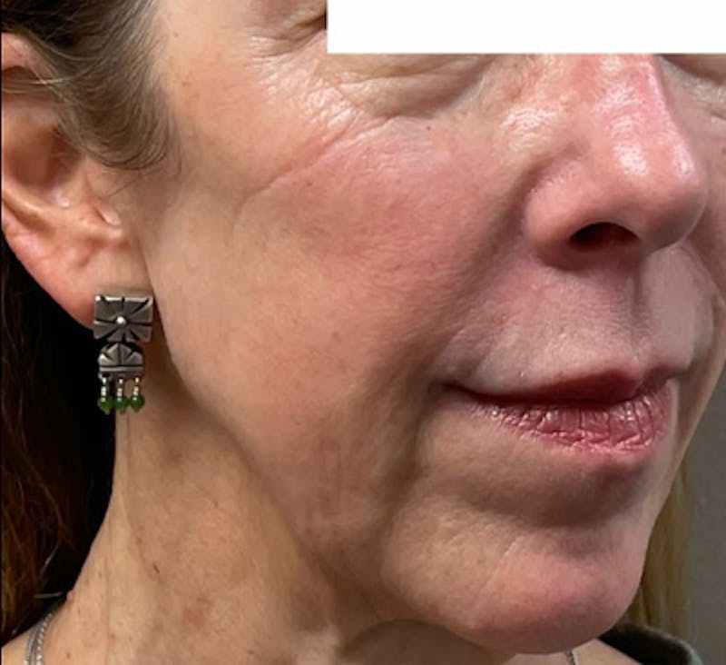 PDO Thread Lift Before & After Gallery - Patient 788992 - Image 1