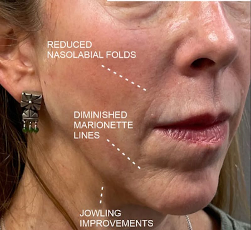 PDO Thread Lift Before & After Gallery - Patient 788992 - Image 2