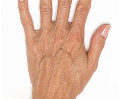 Radiesse for Hand Rejuvenation Before & After Gallery - Patient 247664 - Image 1