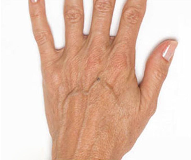 Radiesse for Hand Rejuvenation Before & After Gallery - Patient 247664 - Image 1