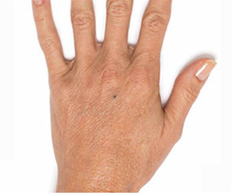 Radiesse for Hand Rejuvenation Before & After Gallery - Patient 247664 - Image 2
