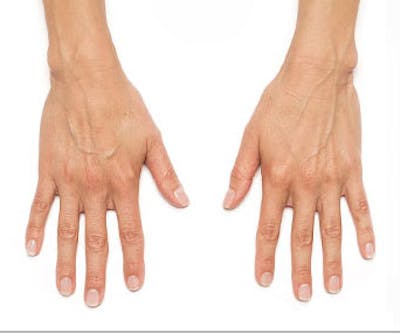 Radiesse for Hand Rejuvenation Before & After Gallery - Patient 682095 - Image 1