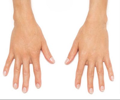 Radiesse for Hand Rejuvenation Before & After Gallery - Patient 682095 - Image 2