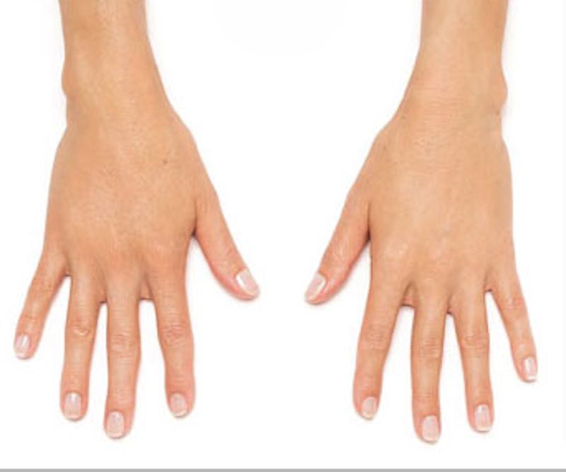 Radiesse for Hand Rejuvenation Before & After Gallery - Patient 682095 - Image 2