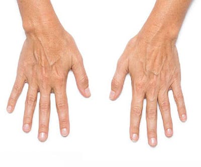 Radiesse for Hand Rejuvenation Before & After Gallery - Patient 294191 - Image 1