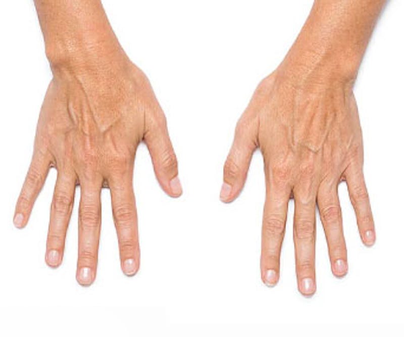 Radiesse for Hand Rejuvenation Before & After Gallery - Patient 294191 - Image 1